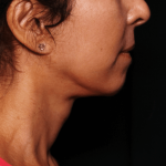 Neck Lift Before & After Patient #30795