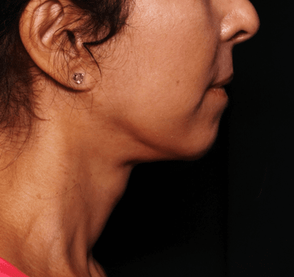 Neck Lift Before & After Patient #30795