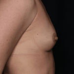 Breast Before & After Patient #30775