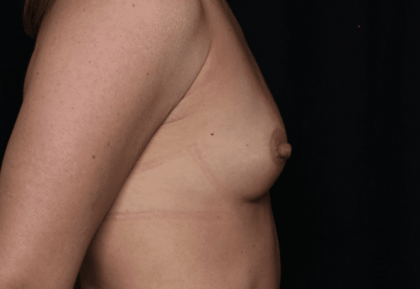 Breast Before & After Patient #30775