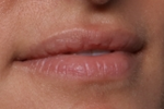 Lip Filler Before & After Patient #30788