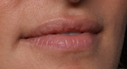 Lip Filler Before & After Patient #30788