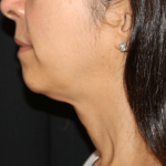 Neck Lift Before & After Patient #30795