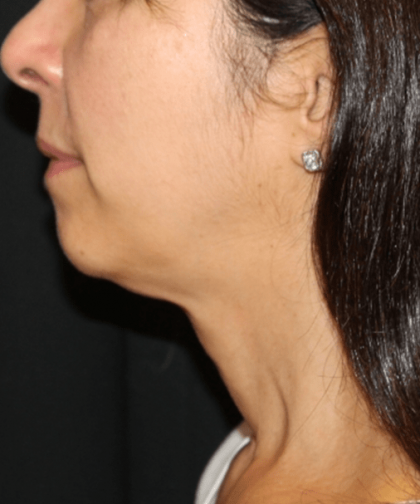 Neck Lift Before & After Patient #30795