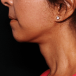 Neck Lift Before & After Patient #30795