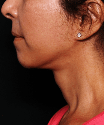 Neck Lift Before & After Patient #30795