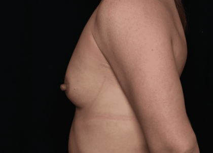 Breast Before & After Patient #30775