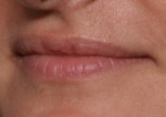 Lip Filler Before & After Patient #30788
