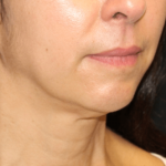 Neck Lift Before & After Patient #30795