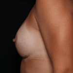 Breast Before & After Patient #30775