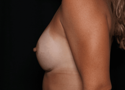 Breast Before & After Patient #30775