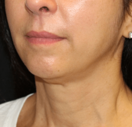 Neck Lift Before & After Patient #30795