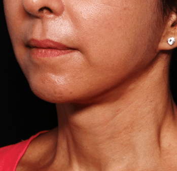 Neck Lift Before & After Patient #30795