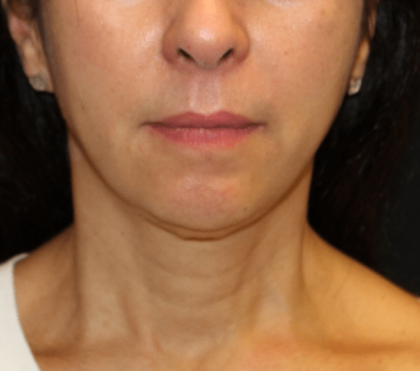 Neck Lift Before & After Patient #30795