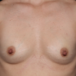 Breast Augmentation Before & After Patient #30740