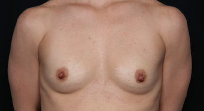 Breast Augmentation Before & After Patient #30740