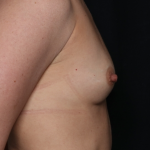 Breast Augmentation Before & After Patient #30740