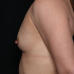 Breast Augmentation Before & After Patient #30740