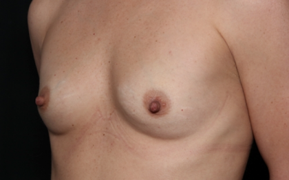 Breast Augmentation Before & After Patient #30740