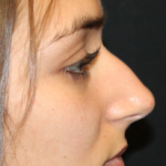 Rhinoplasty Before & After Patient #30753