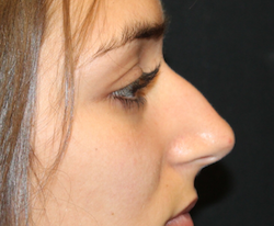 Rhinoplasty Before & After Patient #30753