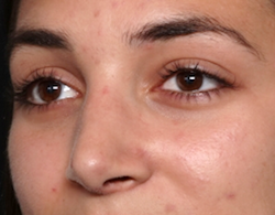 Rhinoplasty Before & After Patient #30753