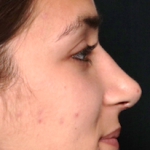 Rhinoplasty Before & After Patient #30753