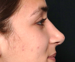 Rhinoplasty Before & After Patient #30753