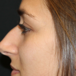 Rhinoplasty Before & After Patient #30753