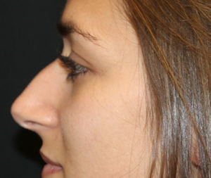 Rhinoplasty Before & After Patient #30753