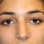 Rhinoplasty Before & After Patient #30753