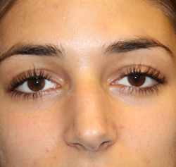 Rhinoplasty Before & After Patient #30753