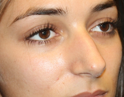Rhinoplasty Before & After Patient #30753