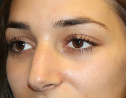 Rhinoplasty Before & After Patient #30753