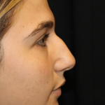 Rhinoplasty Before & After Patient #30883