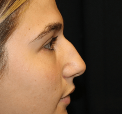 Rhinoplasty Before & After Patient #30883