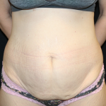 Tummy Tuck Before & After Patient #30872