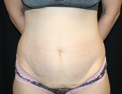 Tummy Tuck Before & After Patient #30872