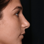 Rhinoplasty Before & After Patient #30883