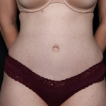 Tummy Tuck Before & After Patient #30872