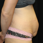 Tummy Tuck Before & After Patient #30872