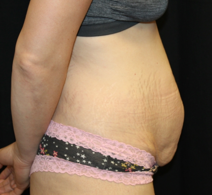 Tummy Tuck Before & After Patient #30872