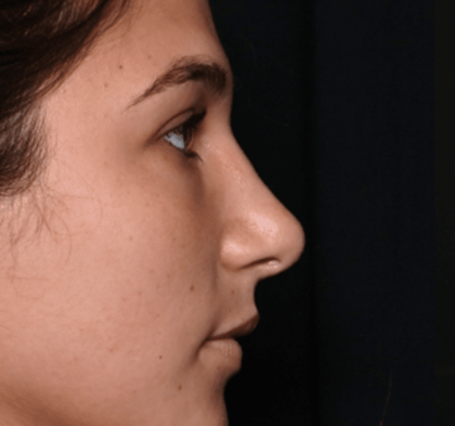 Rhinoplasty Before & After Patient #30883