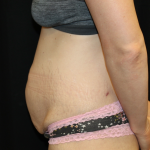 Tummy Tuck Before & After Patient #30872