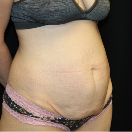 Tummy Tuck Before & After Patient #30872