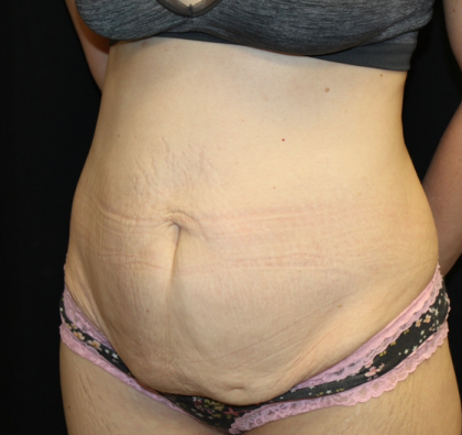 Tummy Tuck Before & After Patient #30872