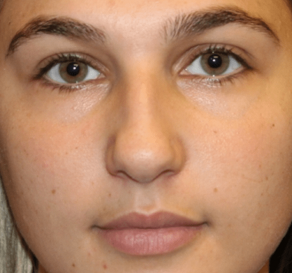 Rhinoplasty Before & After Patient #30883