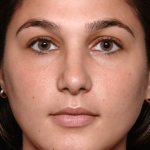 Rhinoplasty Before & After Patient #30883