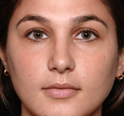 Rhinoplasty Before & After Patient #30883