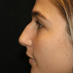 Rhinoplasty Before & After Patient #30883